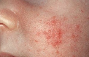 Дерматит та нейродерміт є одним із симптомів алергії при лактації