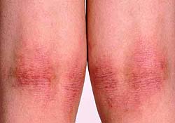 Головною причиною розвитку ускладнень при атопічний дерматит служить постійне травмування шкіри в результаті її розчісування