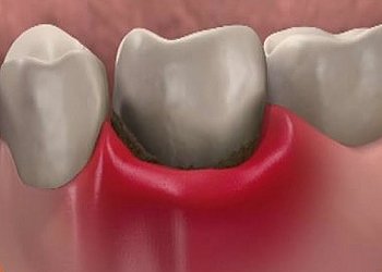 Після пломбування зуб нерідко реагує на гаряче і холодне, але далеко не завжди це - ознака поганого або неякісного лікування