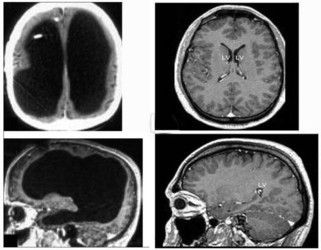 24 липня 2007, 14:21 Переглядів:   Знімки головного мозку пацієнта (зліва) і звичайного здорової людини (справа), newscientist