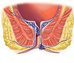Гемороєм називається процес, коли відбувається варикозне розширення вен прямої кишки і заднього проходу
