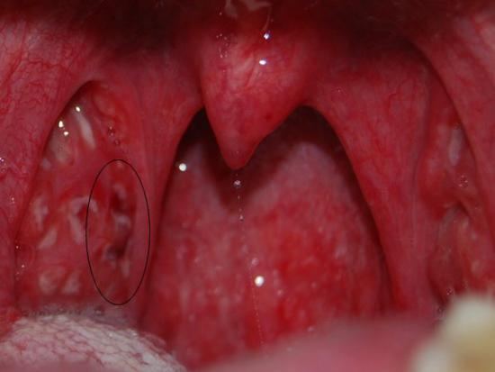 Хронічний тонзиліт розвивається на тлі збільшених аденоїдів;  викривлення носової перегородки, гнійних синуситів, погано залічені зуби також провокують хронічний перебіг тонзиліту