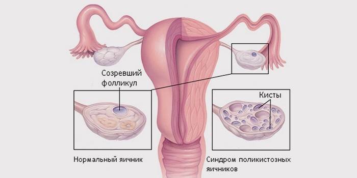 гормональні засоби, що підвищують рівень прогестерону;   оральні контрацептиви, що перешкоджають овуляції;   знеболюючі ліки - «Ібуфен ®», «Парацетамол» і спазмолітики на час місячних