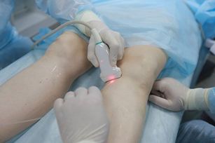 Ендовазальной лазерна коагуляція вен, на відміну від хірургічної операції з видалення вен на ногах, - щадна безопераційна методика лікування варикозу, в результаті використання якої відбувається облітерація (заращіваніе, «споювання») уражених вен