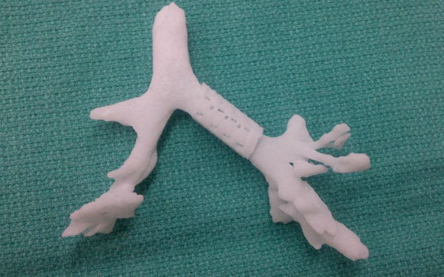 Цю задачу вирішила технологія 3D-друку: макет трубки можна робити за індивідуальним замовленням, щоб створити фіксатор саме такої форми і розміру, який підійде конкретному пацієнту