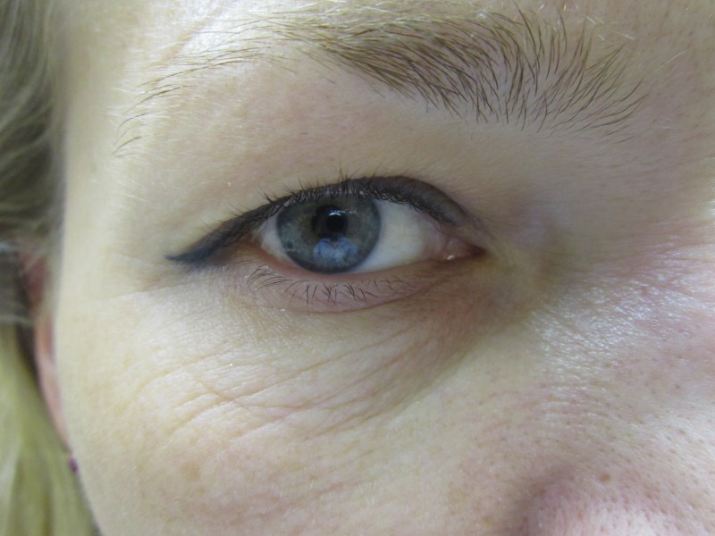 Найпоширенішою проблемою, з якою звертаються в наш центр, є зона навколо очей: дрібна сіточка зморшок, набряклість, зниження тургору шкіри, гусячі лапки