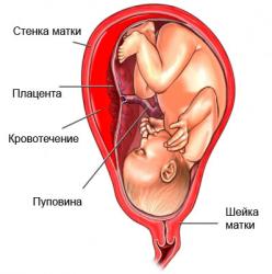 поліпи матки   є вельми поширеною гінекологічною патологією, яка здатна викликати серйозні ускладнення під час   вагітності