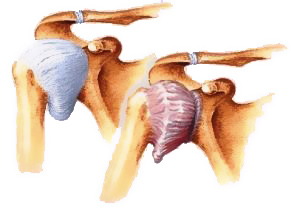 Плечолопатковий периартроз - найпоширеніший вид периартроза