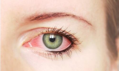 Почервоніння очей - це не тільки естетична проблема, це ще й медичний симптом, яким можуть проявлятися різні захворювання