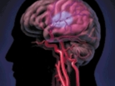 Гідроцефалія характеризується наявністю надмірної кількості цереброспінальної рідини в шлуночкової системі головного мозку