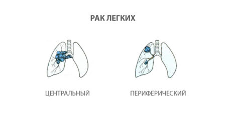 Погіршення здоров'я спостерігається через два-три місяці: сухий кашель, біль в легенях, задишка