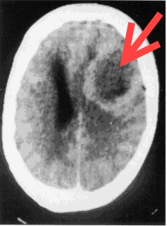 Якщо зробити КТ або МРТ знімок в PCL-A-фазі, то буде видно цей набряк, що традиційна медицина трактує як «пухлина мозку»