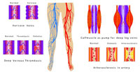 Балонна ангіопластика нижніх кінцівок і її специфіка