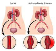 Стентування аневризми черевної аорти