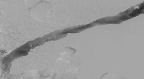 Проміжний результат катетер-керованого тромболізису - поява мінімального кровотоку в початково тотально тромбированной поверхневої стегнової вени