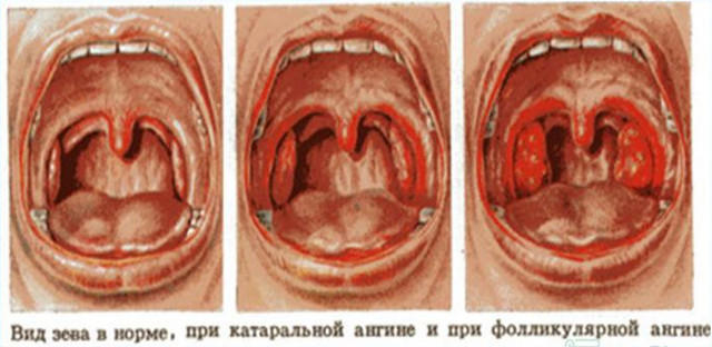 Залежно від виду інфекції можуть сильно відрізнятися підходи до лікування хворого горла