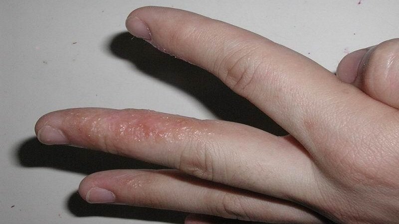Для людини звично чути про таке недугу, як пухирі (водянисті пухирці на руках і інших ділянках шкіри), але мало хто знає, що насправді це таке