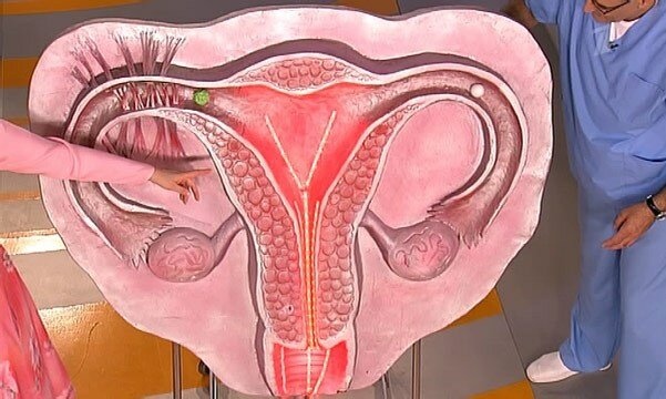 Запальні захворювання є найпоширенішими в жіночій статевій сфері і з них приблизно 60 відсотків займають запалення придатків матки (маткових труб і яєчників)