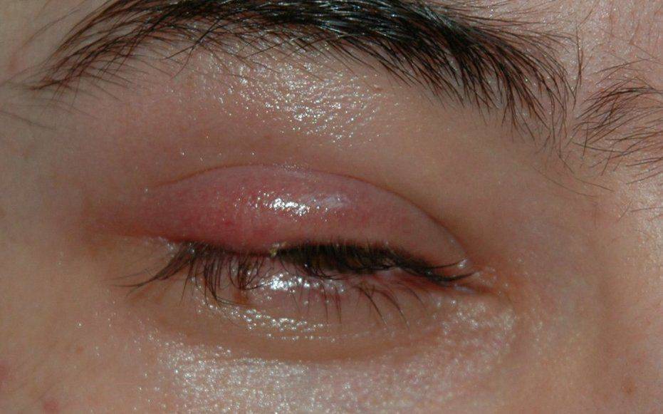 Захворювання в рідкісних випадках переходить на друге око