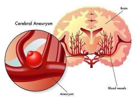 аневризма судин   - це маленьке освіту на мозковому кровоносній судині, яке з часом збільшується і наповнюється кров'ю