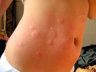 Алергію на укуси бліх у дітей як лікувати