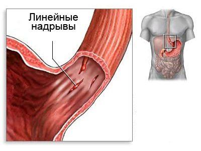 При синдромі Меллорі-Вейса відбувається поздовжнє пошкодження слизової оболонки нижнього (черевного) відділу стравоходу і верхнього (кардіального) відділу шлунка