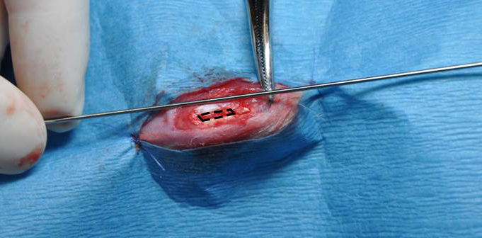 Малюнок 4: хірургічні модель колінного сухожилля дефекту (резекція)
