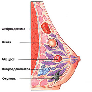 Фіброаденома - це доброякісна пухлина в молочній залозі (пухлина), є однією з форм   вузловий мастопатії   , Найчастіше розвивається на тлі порушення гормонального рівноваги в організмі