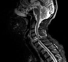 Як відомо, грижа міжхребцевого диска може виникнути не тільки в   поперековому відділі хребта, але і в шийному