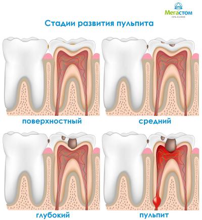Якщо карієс своєчасно не пролікувати, то що мешкають в уражених їм тканинах мікроорганізми проникають далі в порожнину зуба, де розташовується пульпа, що викличе серйозний запальний процес
