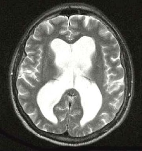 Речовина мозку на знімках позначено сірим кольором, а рідина - білим