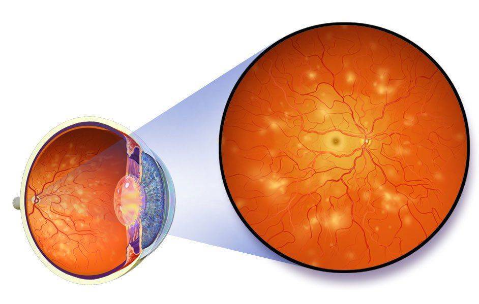 Судини від постійно високої концентрації цукру стають ламкими, відбуваються крововиливи в сітчасту оболонку, в результаті відбувається зниження зорової здатності очей