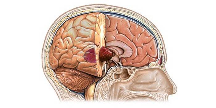 Іноді метастази з'являються відразу в декількох областях органу і починають рости, утворюючи пухлини