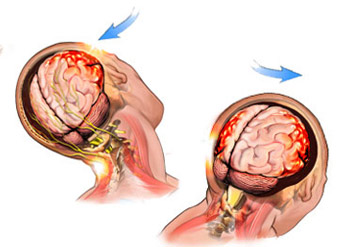 На початку статті було відзначено, що не всі ЧМТ - струс мозку, але все струсу - черепно-мозкова травма