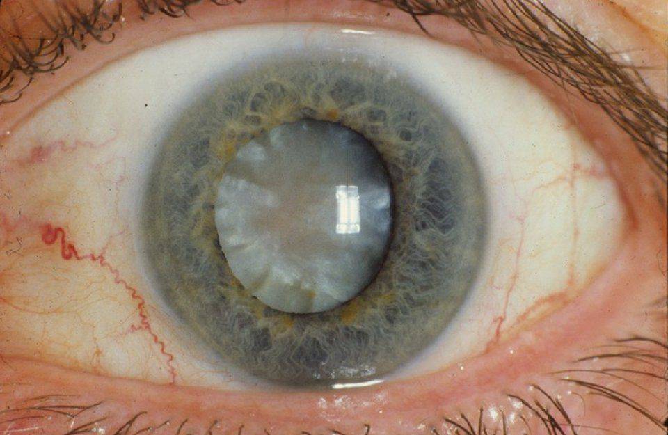 При цьому у більш, ніж 10% людей, які перенесли операцію з видалення кришталика, виникає ускладнення у вигляді вторинної катаракти