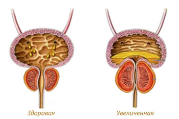 Аденома простати, або доброякісна гіперплазія передміхурової залози (ДГПЗ) - рясне розростання тканин передміхурової залози, яке провокує появу новоутворень