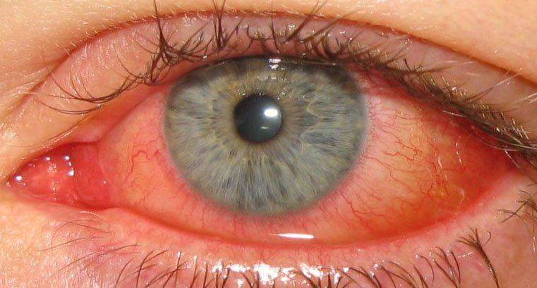 Свербіж, подразнення, сльозотеча очей - всі ці симптоми вірні супутники хвороби