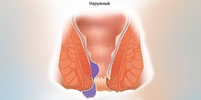 дискомфорт в процесі і після спорожнення кишечника, викликаний напругою і зміщенням анальних тканин;   тріщини заднього проходу, які кровоточать після відвідування туалету;   сильні кровотечі і слизові виділення з ануса   сильне свербіння, печіння всередині нижньої частини прямої кишки;   при важкому ступені хвороби больові відчуття починають виникати при русі і напрузі мускулатури ануса