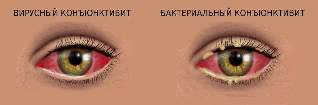 Якщо видалення не справити вчасно, можуть виникнути різні патології: кон'юнктивіти, блефарити та інше