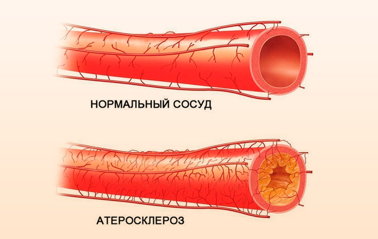 Посилюється і дієта при гіпертонії 2 ступеня