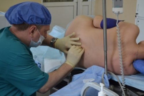 Що таке епідуральна анестезія