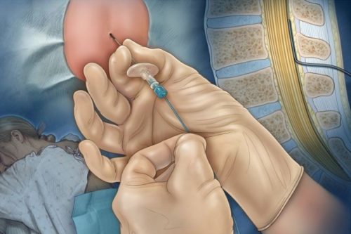 Як роблять епідуральну анестезію