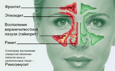 види етмоїдити