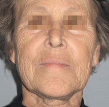 Клінічні приклади використання методу фракційного фототермоліза