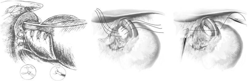 Особливість фундопликации по Тупе полягає в формуванні симетричною манжетки з передньої і задньої стінок фундального відділу шлунка