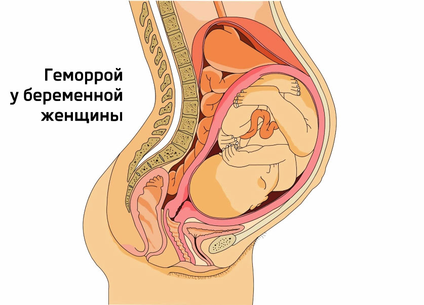 Найголовніша особливість і проблема геморою у вагітних - його шкода для ненародженої дитини