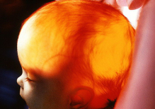 Водянка головного мозку (гідроцефалія) у новонароджених - стан, при якому є скупчення в надмірних кількостях ліквору (спинномозкової рідини) в шлуночках головного мозку