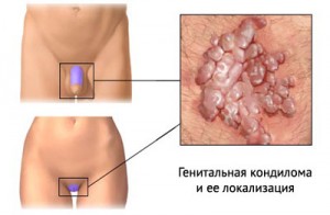 У чоловіків гострокінцеві кондиломи локалізуються на крайньої плоті, голівці і шийці головки статевого члена, в області зовнішнього отвору сечовипускального каналу, а іноді і в самому каналі