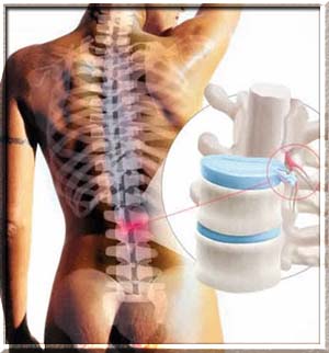 Прийнято вважати, що болем в спині людина розплачується за можливість ходити на двох ногах