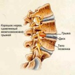 Міжхребетні диски - своєрідні подушки, які діють як амортизатори між кожним хребцем у Вашому хребті